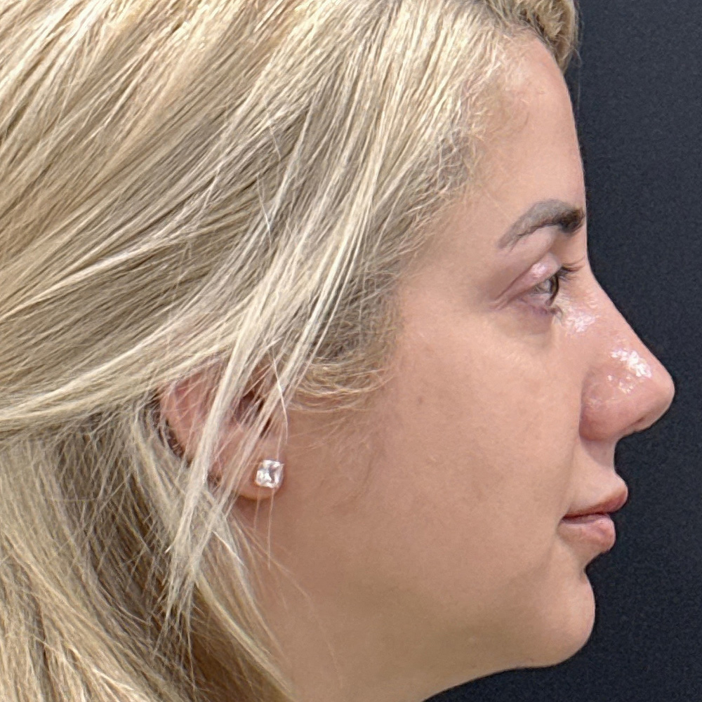 Case--8873 | After Rhinoplasty 2