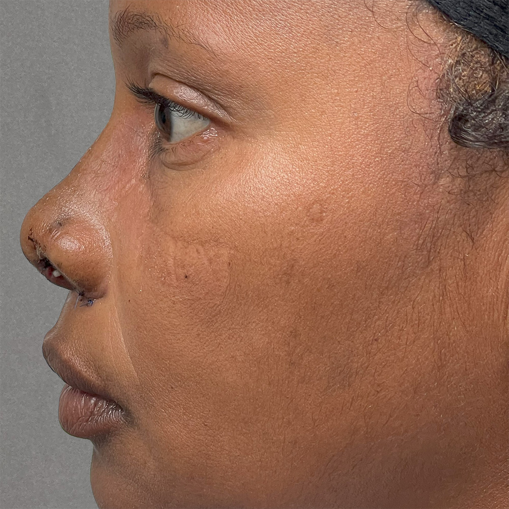 Case--2060 | After Rhinoplasty 2