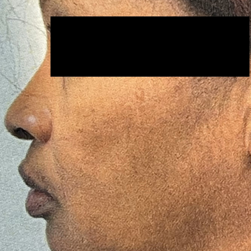 Case--2060 | Before Rhinoplasty 2