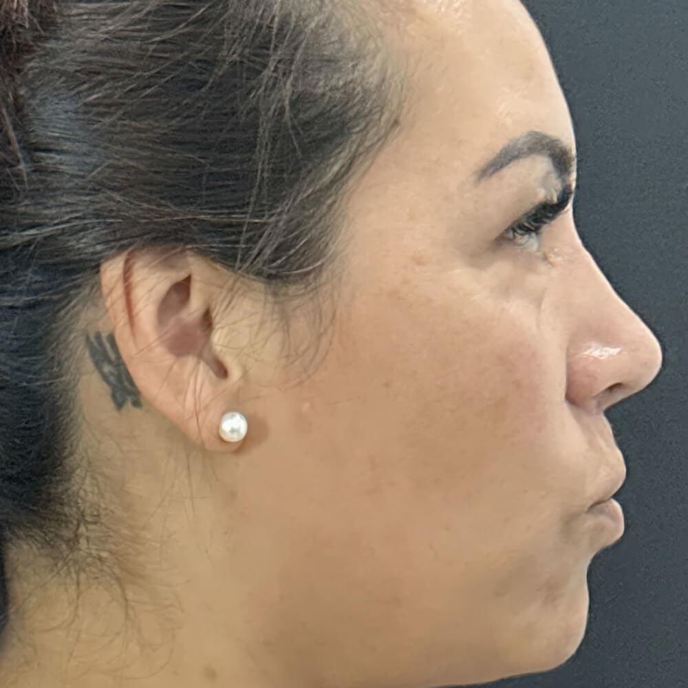 Case--3940 | After Rhinoplasty 2