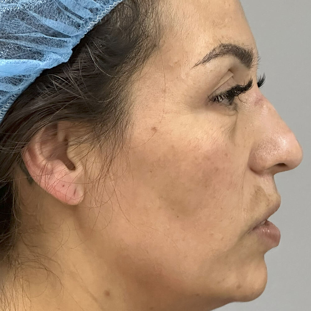 Case--3940 | Before Rhinoplasty 2